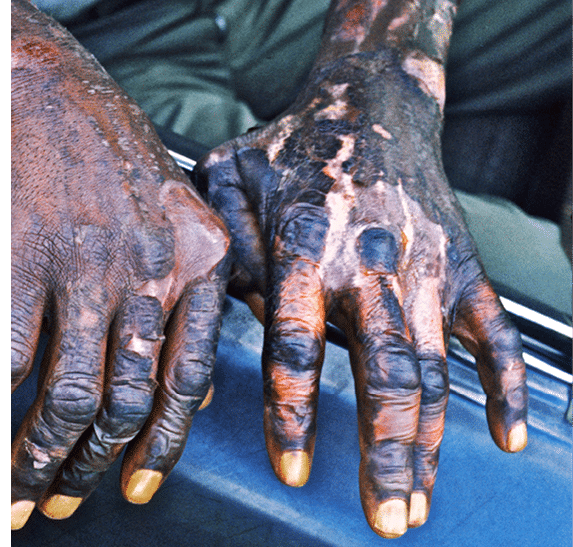 1974 - Gainesville, AL