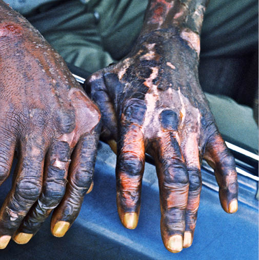 1974 - Gainesville, AL